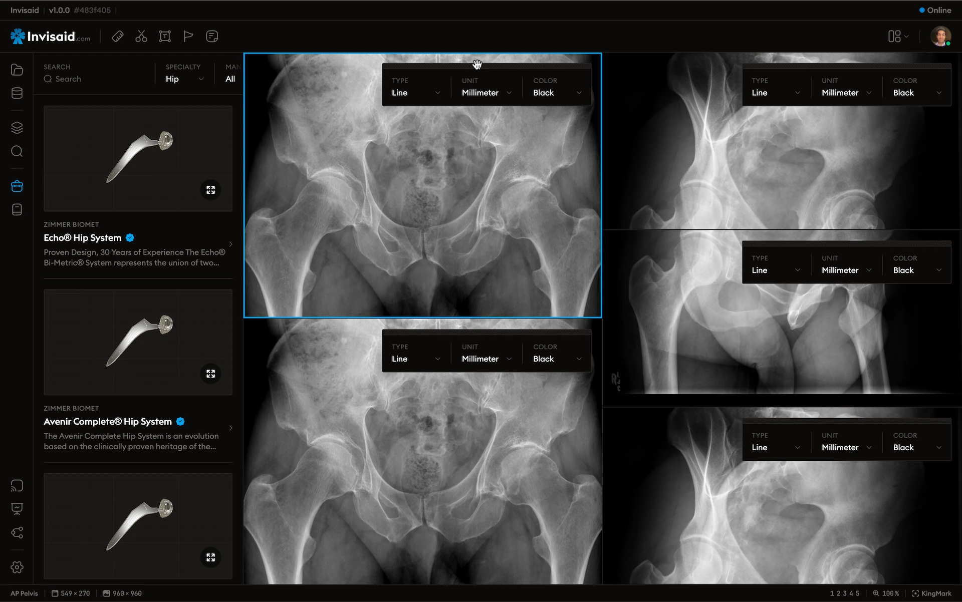 A screenshot of Invisaid, the preoperative orthopedic planning software, in dark mode.