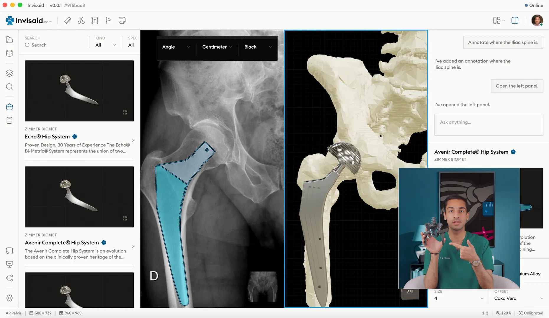 A screenshot of Invisaid, the surgical preoperative orthopedic planning software showcasing a total hip replacement procedure being planned with the Zimmer Biomet Avenir Hip System.