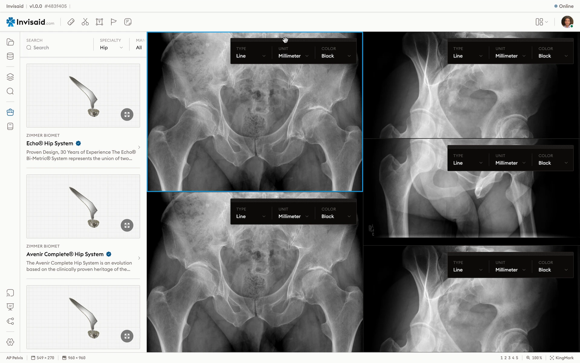 A screenshot of Invisaid, the preoperative orthopedic planning software.