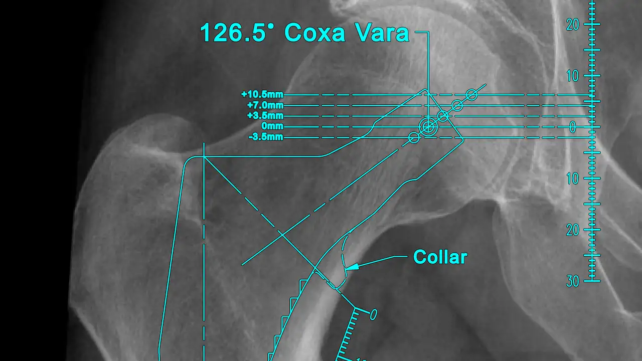 Radiograph of a pelvis with a cyan template of the Avenir Complete® Hip System by Zimmer Biomet.
